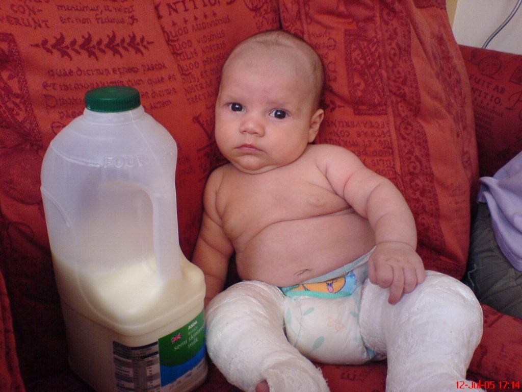 Clubfoot challenges and victories: A parent's Story 12 years On