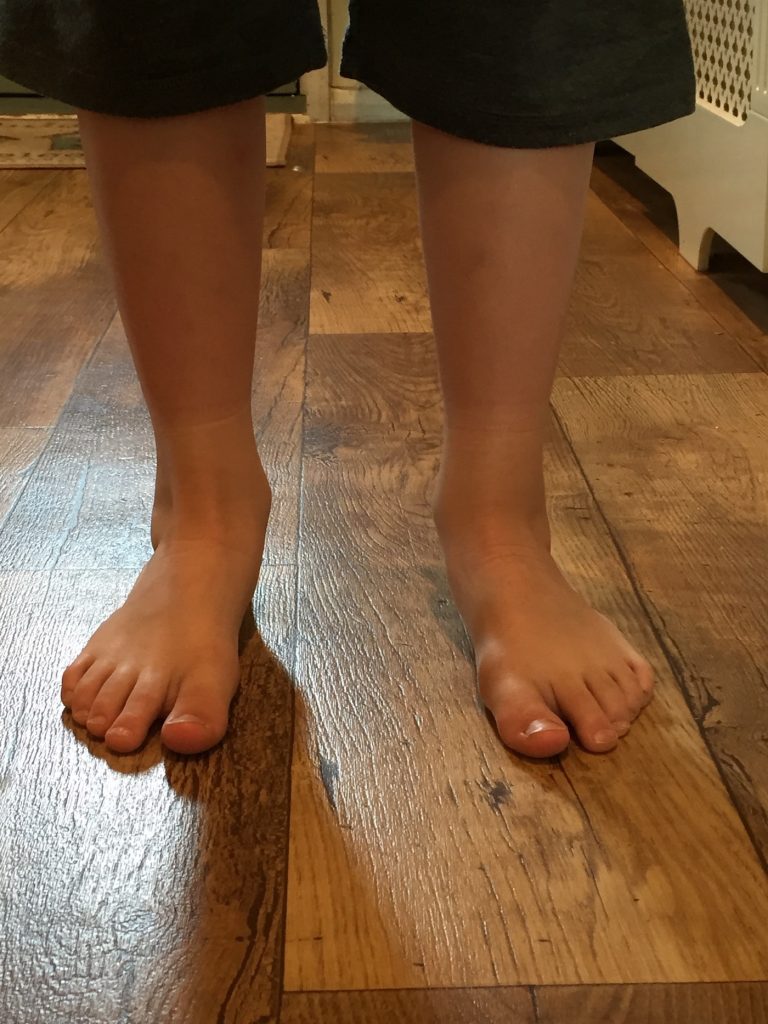 Clubfoot challenges and victories: A parent's Story 12 years On